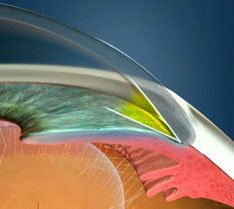 Причины, симптомы и лечение закрытоугольной глаукомы