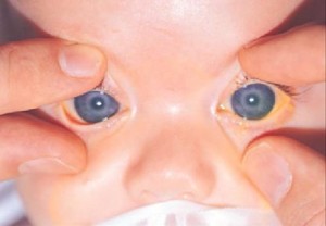 Что делать если у ребенка врожденная глаукома?