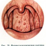 Гранулезный фарингит. Чем лечить?