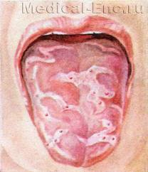 Заболевание полости рта глосситом