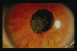 Лечение и клиническая картина рефрактерной глаукомы