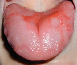 Ромбовидный глоссит полости рта