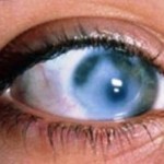 Посттравматическая глаукома: клинические проявления и методы лечения