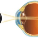 Как проводиться операция на глаза при дальнозоркости?